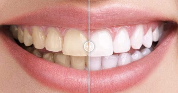 Before & After Images Comparison WordPress Plugin
